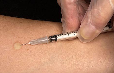 Šiandien minima Tarptautinė tuberkuliozės diena