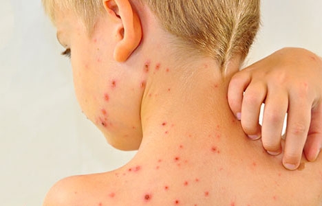 Patikimiausia apsauga nuo tymų – skiepai