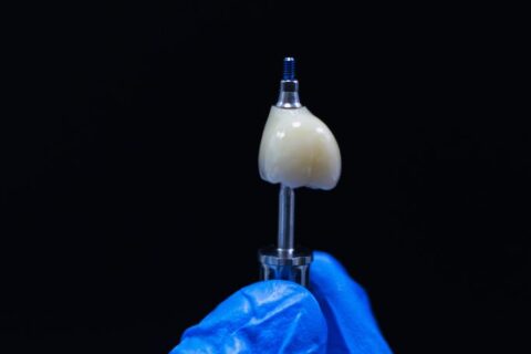 Dantų implantacija Vilniuje: visas gydymo procesas nuo konsultacijos iki naujo danties